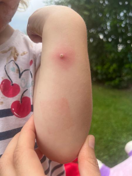 Jak řešit silnou reakci na štípnutí od komára?