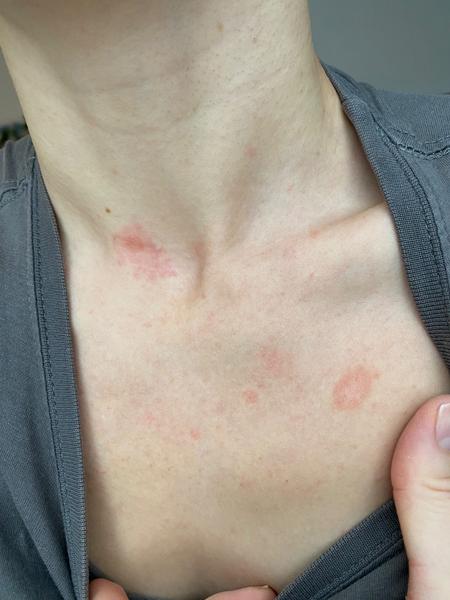 Vystouplá vyrážka: Atopická dermatitida nebo kandida?