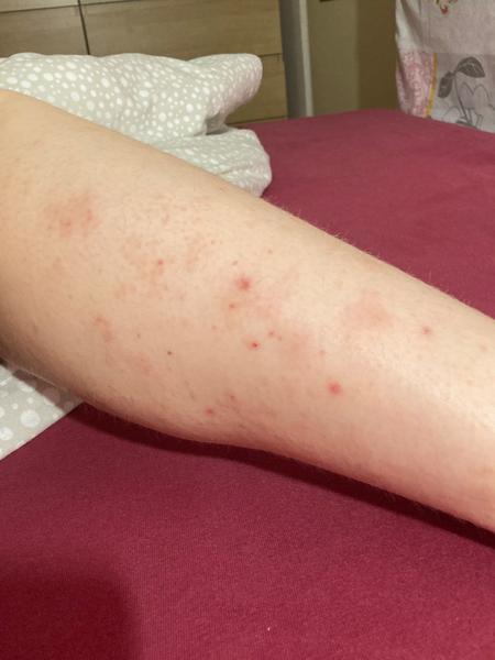 Vyrážka a skvrny na nohou. Co by to mohlo být?