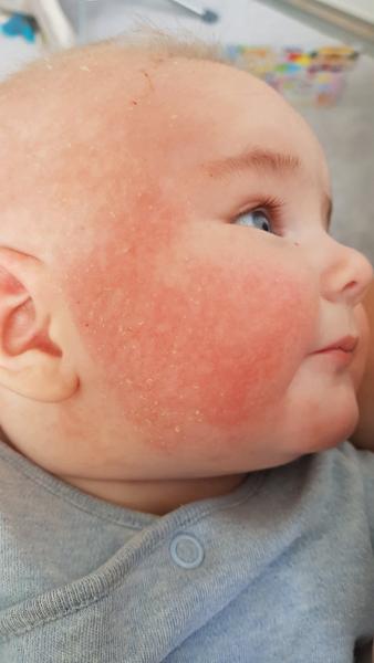 Ekzém / Seborea. Co by to mohlo být?