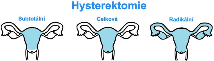 Hysterektomie