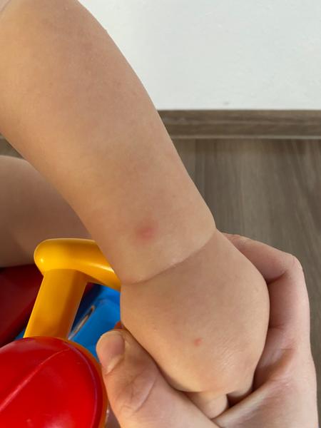 Co způsobuje bolestivé červené pupínky po prodělaném covidu?