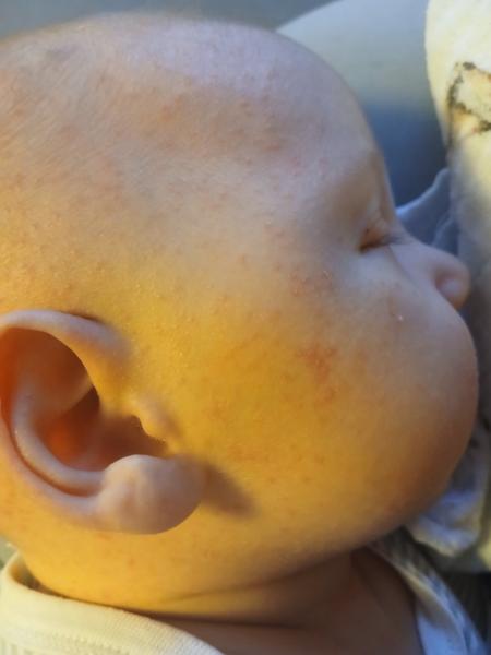 Seborea / novorozenecké akné / ABKM. Co by to mohlo být?