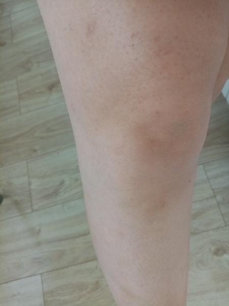 Modřiny na dolních končetinách - z čeho můžou být?