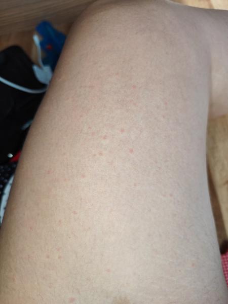 Kožní vyrážka po antibiotikách. Co ji způsobuje?