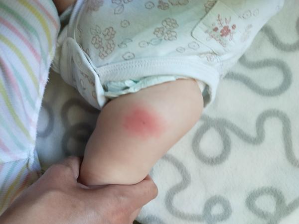 Flek po očkování hexavakcínou. Je to normální?