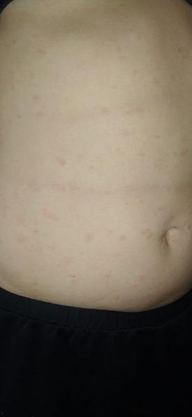 Kožní vyrážka - svědí. Co na ni?