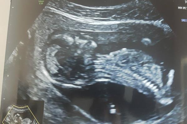 Ultrazvuk - co to bude?