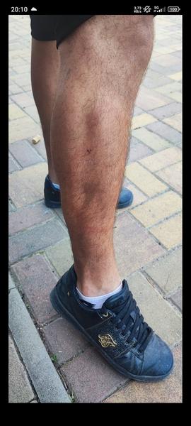 Červené ohraničení na noze. Co by to mohlo být?