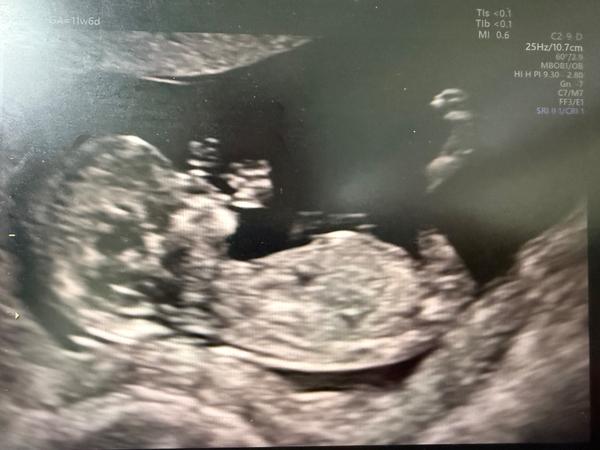 Pohlaví podle screeningu ve 12. týdnu. Co myslíte?