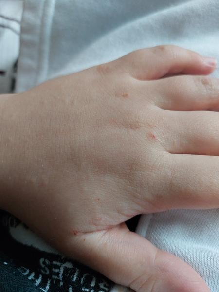 Vyrážka. Co by to mohlo být?