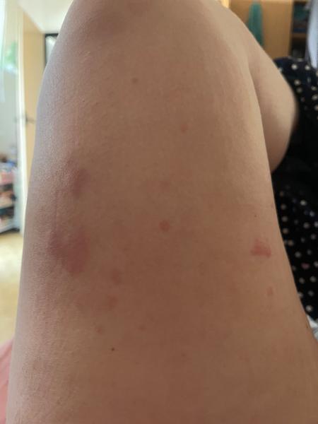 Alergie nebo kopřivka?