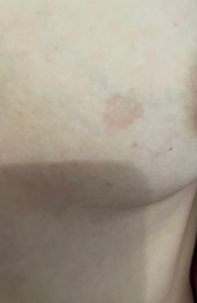 Zarudnutí kůže na prsu. Co by to mohlo být?