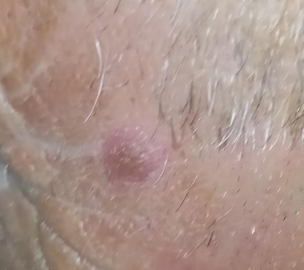 Útvar na kůži čela. Co to může být?