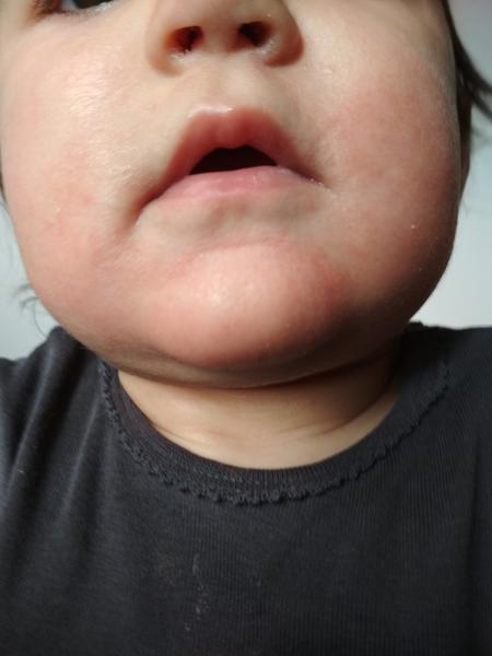 Trvající zarudnutí okolo úst u roční dcery. Prosím, poradíte?