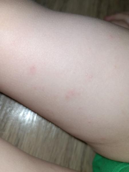 Možná opožděná reakce na Ospamox? Jak na pupínky reagovat?