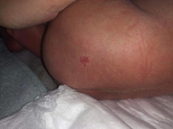 Co znamená vyrážka na zadečku osmnáctidenního miminka?