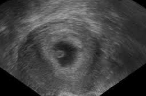 Je normální, že srdce plodu ještě nebije?