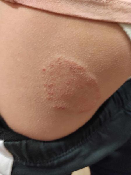 Vyrážka. Nevíte, co by to mohlo být a co by to mohlo značit za problém v těle?