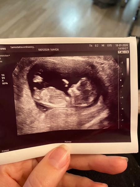 Pohlaví dítěte. Je možné jej odhadnout?