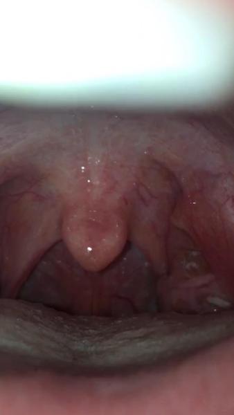 Je moučnivka příčinou bílých skvrn v ústech?