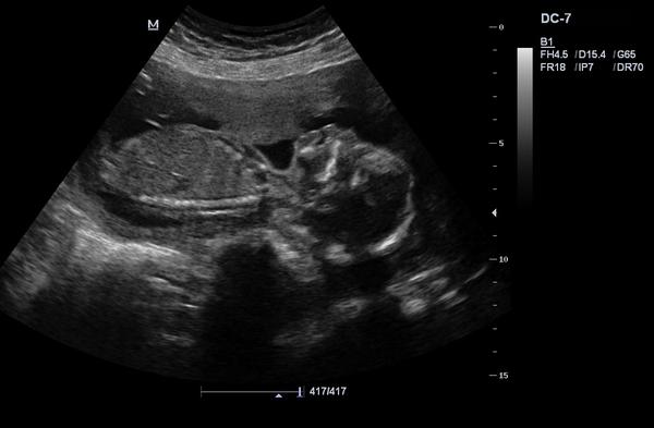 Znáte metody určování pohlaví miminka podle ultrazvuku?