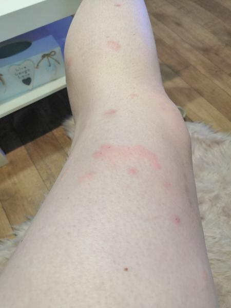 Červené fleky na nohách. O co by se mohlo jednat?