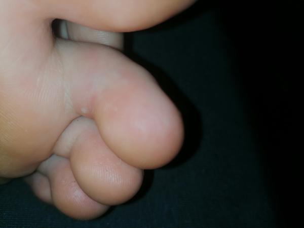 Co způsobuje bolestivé bílé pupínky na noze?