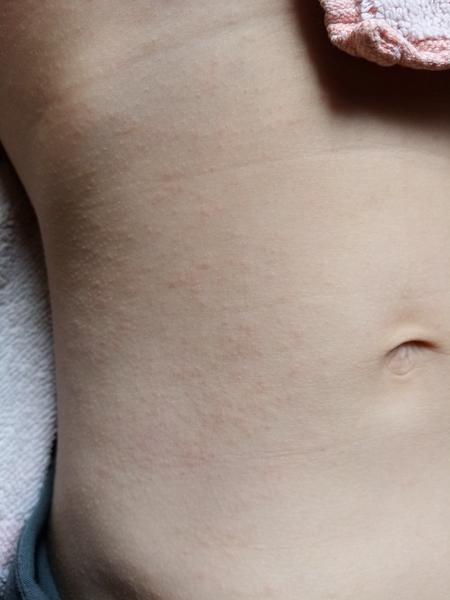 Vyrážka. Co by to mohlo být?