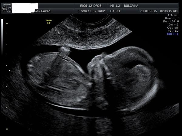 Chlapeček nebo holčička?