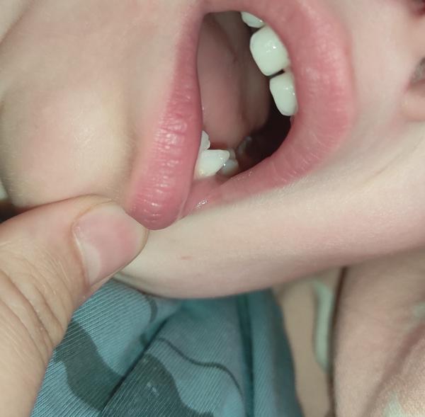 Je to počínající kaz? Jak poznat příznaky zubního kazu?

