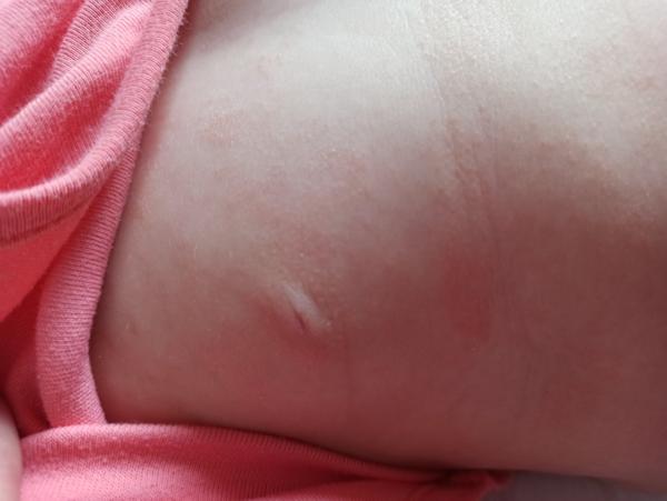 Krupička na bříšku u miminka. Jaké jsou příčiny a řešení?