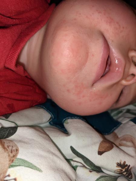 Atopický ekzém u dítěte: Jaké jsou příznaky?