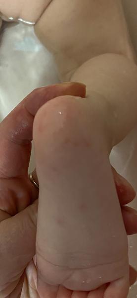 Vyrážka. Je možná alergická rekace na bio dětský čaj?