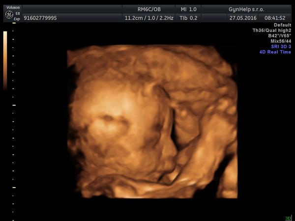 Rozštěp rtu podle 3D ultrazvuku?