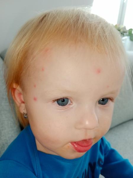 Pupínky. Je možné, že jsou to neštovice?