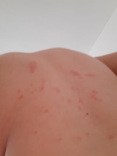 Máte zkušenost s červenými fleky na kůži?