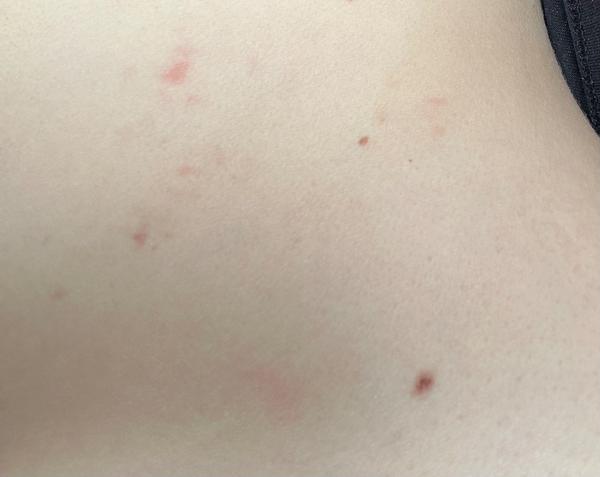 Červené fleky na břiše. Jak řešit jejich příčinu?