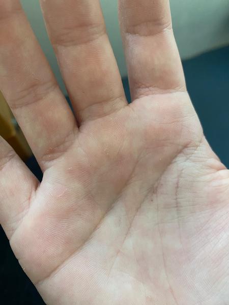 Je to svrab? Jak rozpoznat svrab a co s ním dělat?