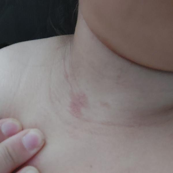 Zkušenosti s výskytem suchých fleků na tváři?