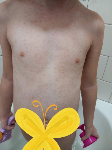 Vyrážka, alergie nebo ekzém?