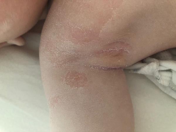 Ekzém nebo kvasinka. Jak a čím pokračovat v léčbě?