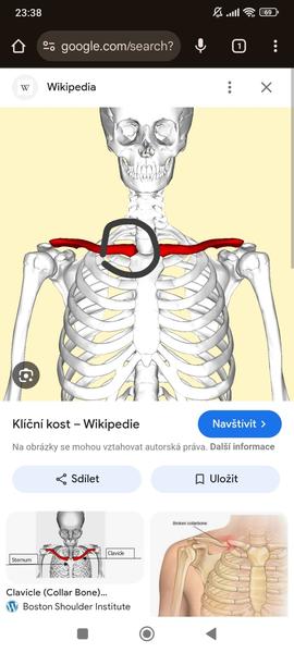 Bolest klíční kosti
