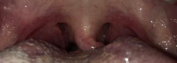 Nemoc. Co mohou být tyto tečky vzadu v krku?