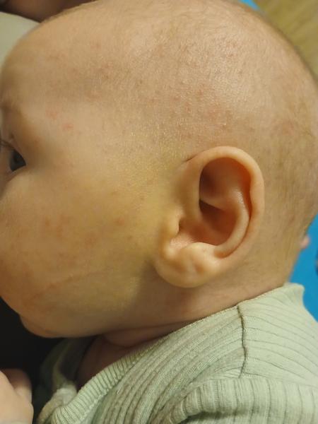 Seborea / novorozenecké akné / ABKM. Co by to mohlo být?