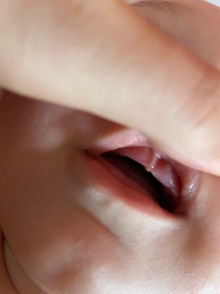 Modřina na dásni u dítěte. Co to může znamenat?