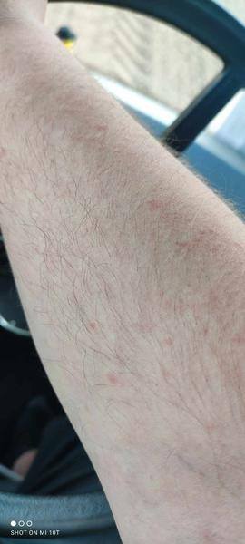 Je to alergie, když pomáhá Fenistil?