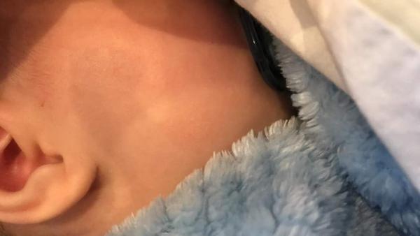 Ekzém či kvasinka?