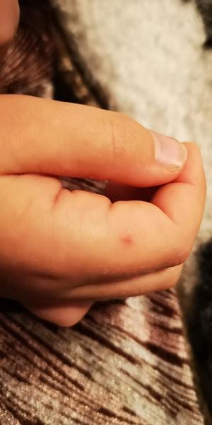 Dcera, 4 roky, teče jí z nosu, zvracela, bez teploty, vyskakují pupínky. Mohou to být neštovice?