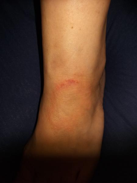 Červený flek na nártu. Borelióza, mykóza nebo něco jiného?